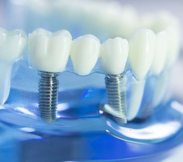 Manassas Dental Implants